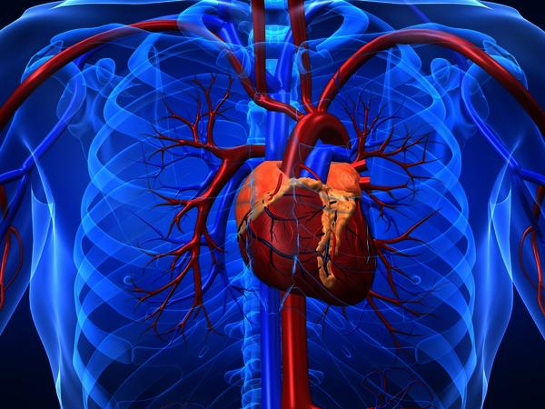 Cardiopatia ischemica